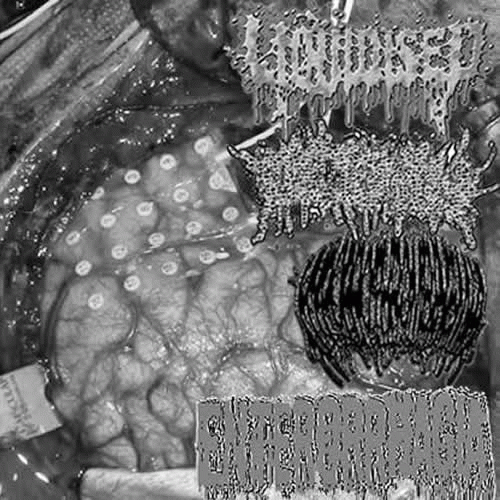 Liquidised : Amebic Meningoencephalitis Due to Naeglaria Fowleri